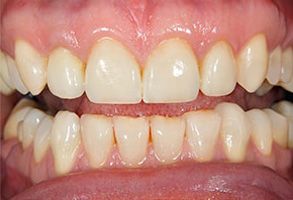 The image displays a close-up view of a person s teeth with a focus on yellowing and staining, which suggests a need for dental care or whitening.