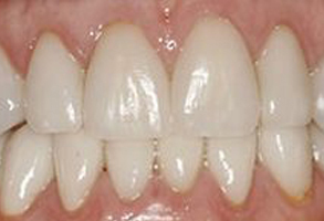 The image shows a close-up view of a person s teeth with a focus on their upper front teeth, which appear to be artificial or veneered, with a natural tooth color transitioning from white to yellow towards the back.