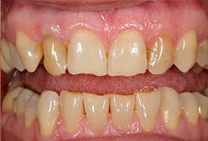The image shows a close-up view of a person s teeth with yellow staining, which suggests dental decay or poor oral hygiene.